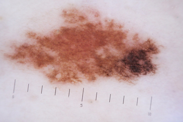 melanoma-in-situ-arising-mole.jpeg