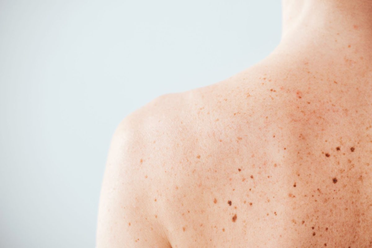 melanoma-check-maitland-1200x801.jpg