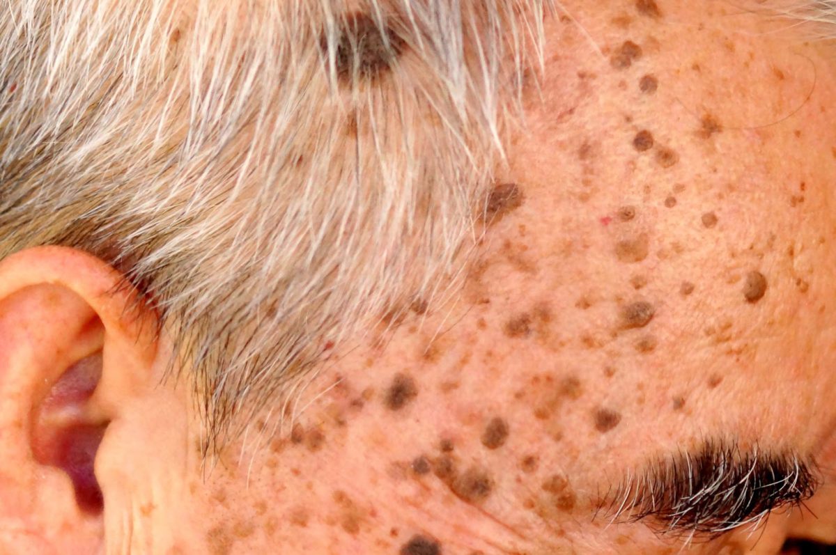 seborrheic-keratosis-1200x797.jpg