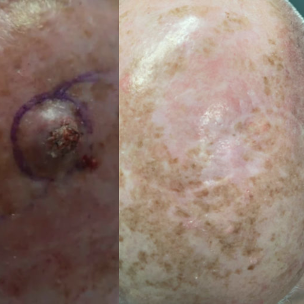 scalp-skin-cancer.png